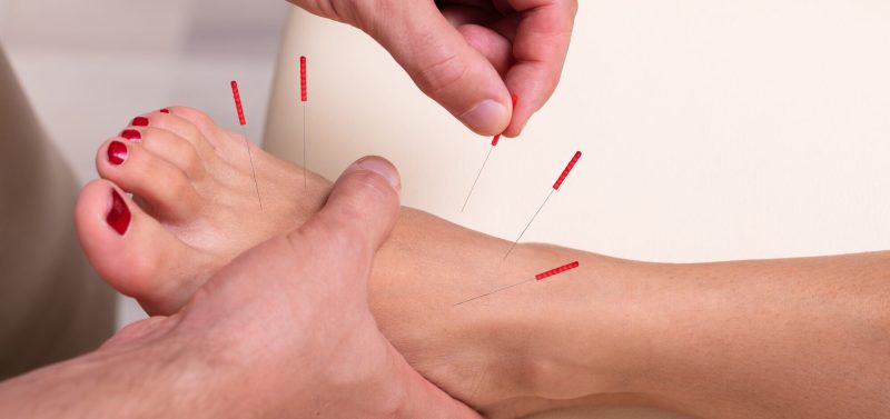 A patient receives dry needling treatments in their foot to help them with their pain.