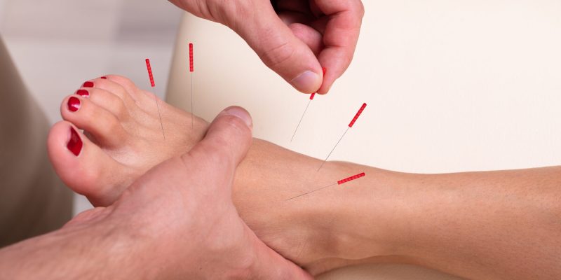 A patient receives dry needling treatments in their foot to help them with their pain.